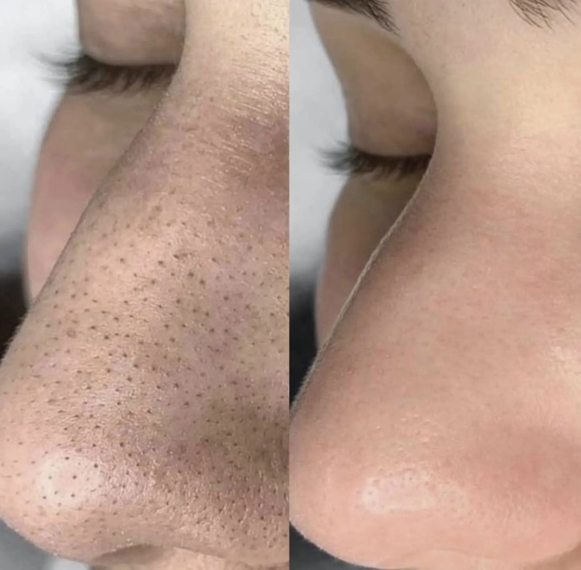 conditions that prevent hydrafacial treatment