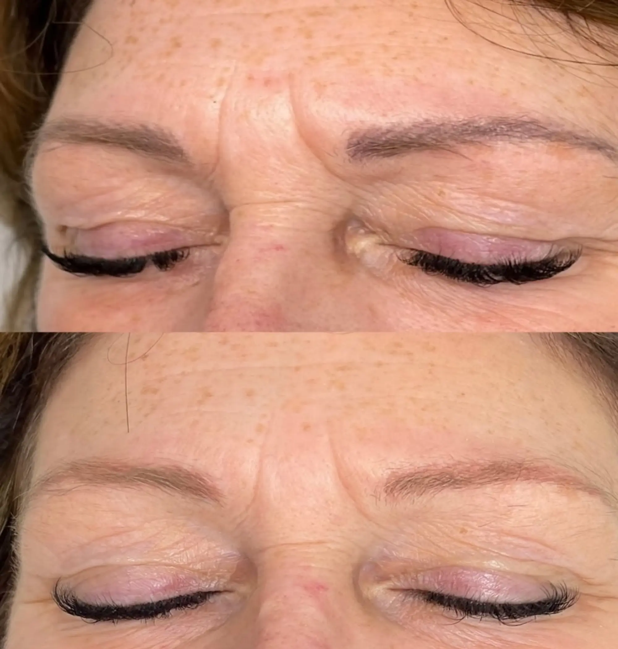 healing stages post cosmetic tattoo removal