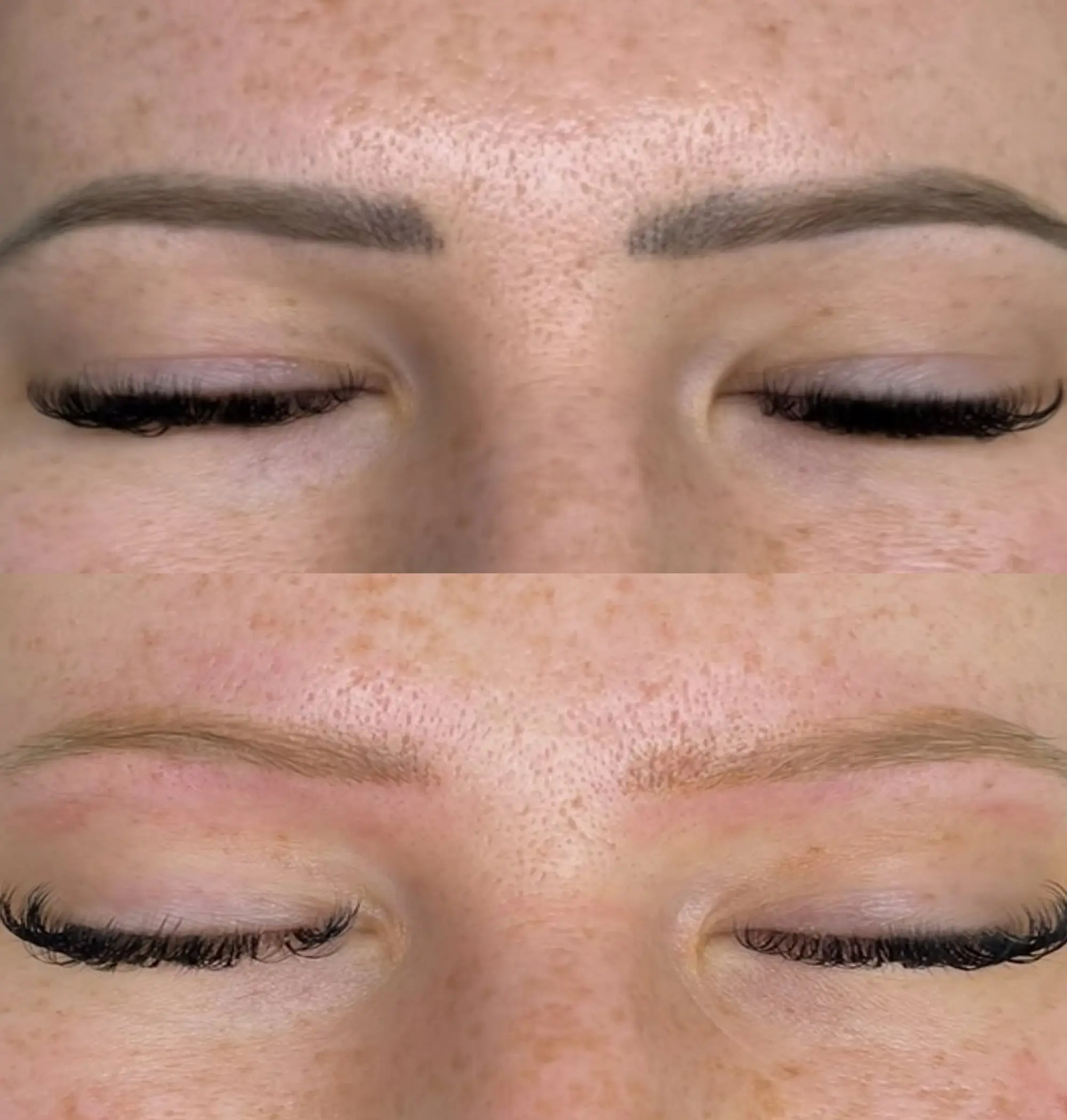 hypopigmentation correction aftercare