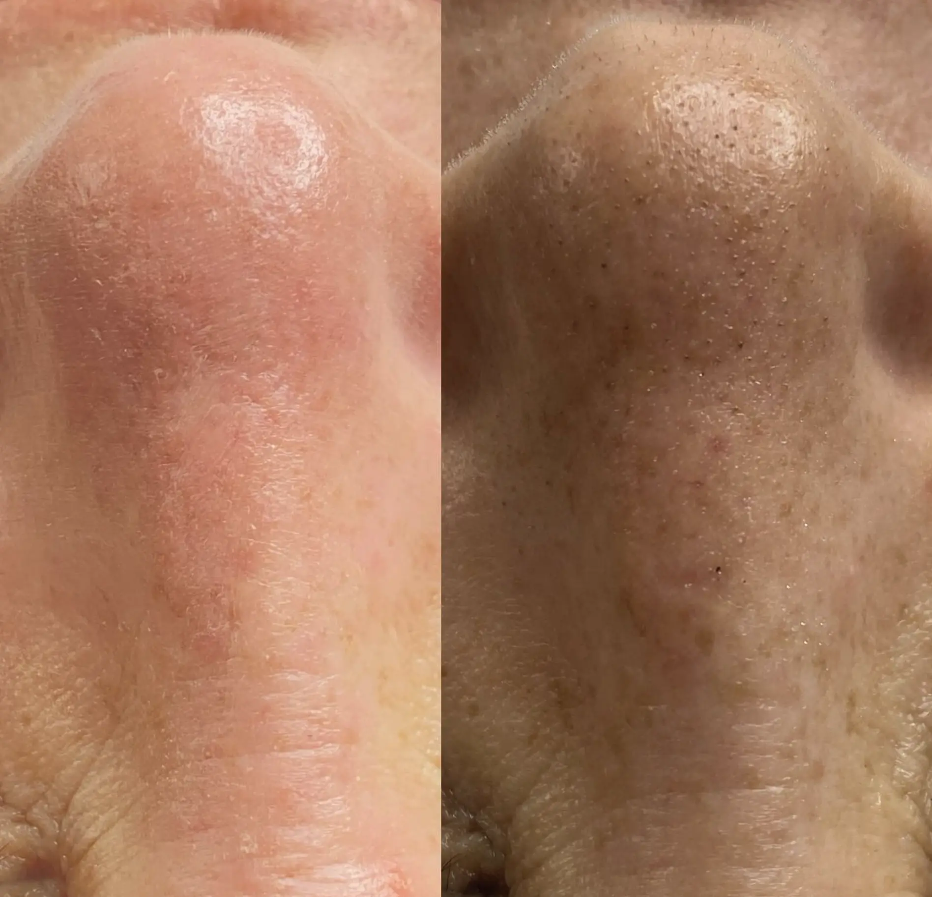 Hydrafacial Safety: Who Should Say No?