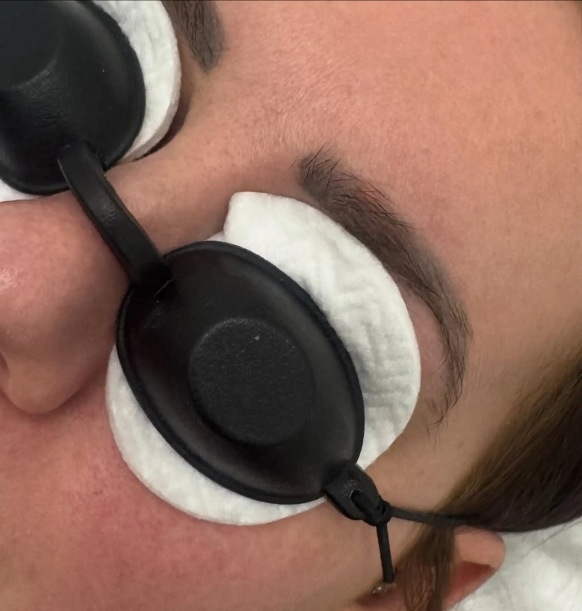natural results of saline lifting
