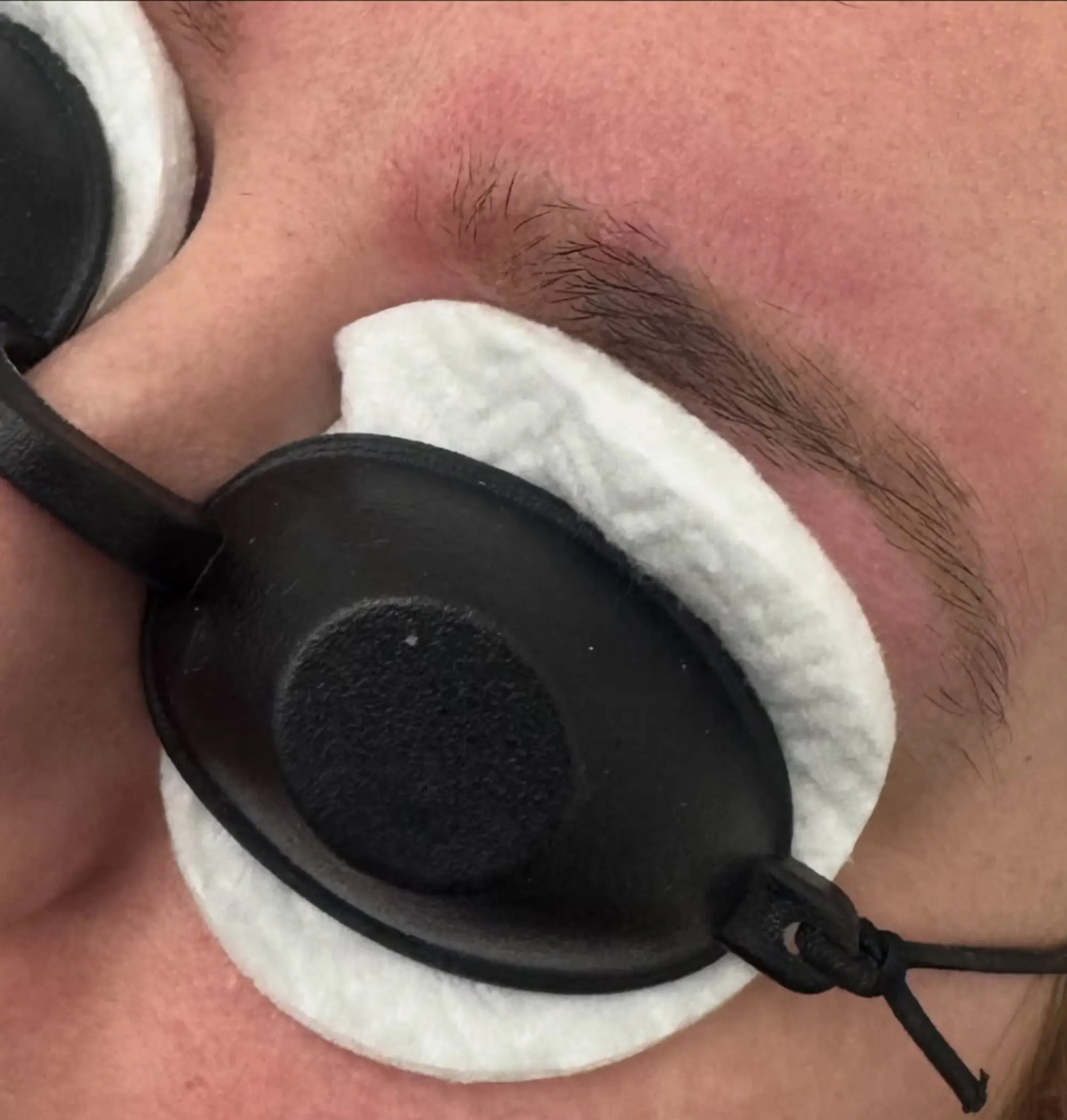 skin healing stages post tattoo removal