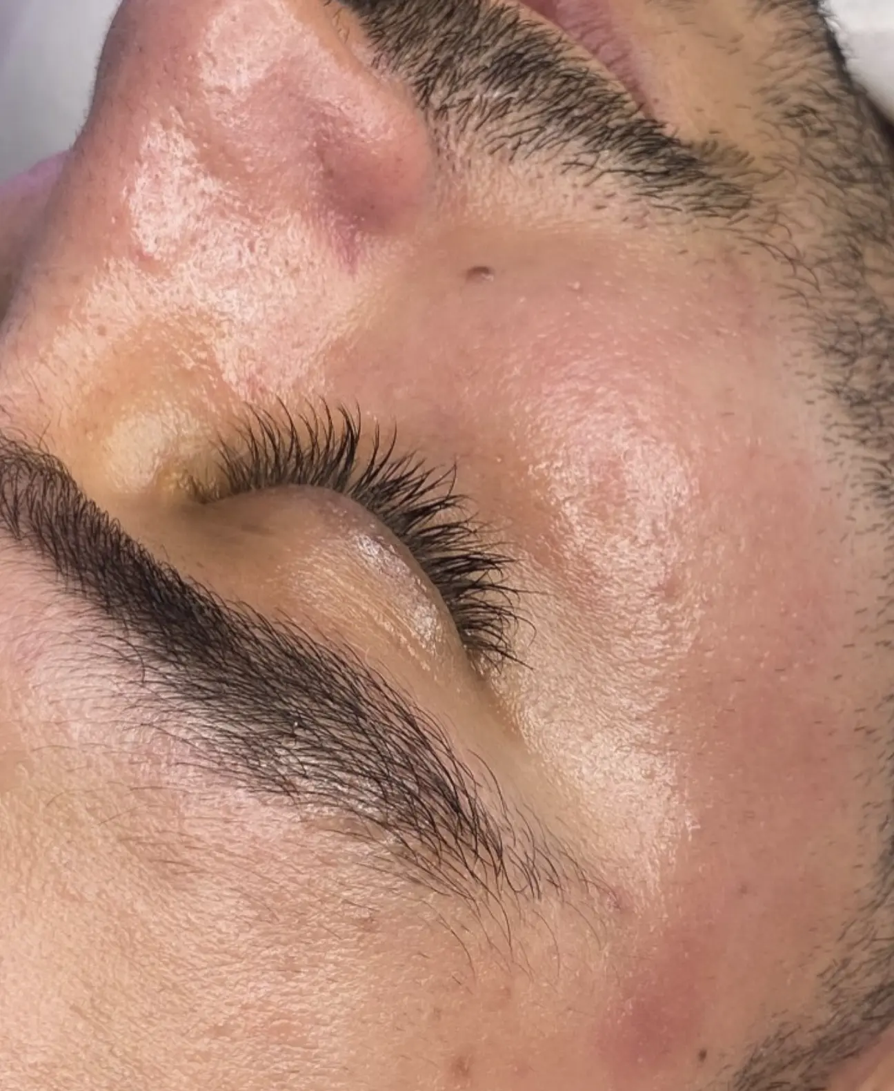 who should not get a hydrafacial
